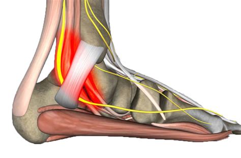 tarsal tunnel syndrome symptoms nhs